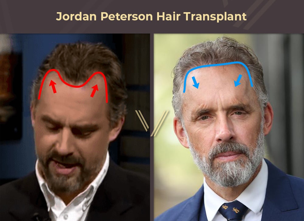 Jordan Peterson Hair Transplant Before and After