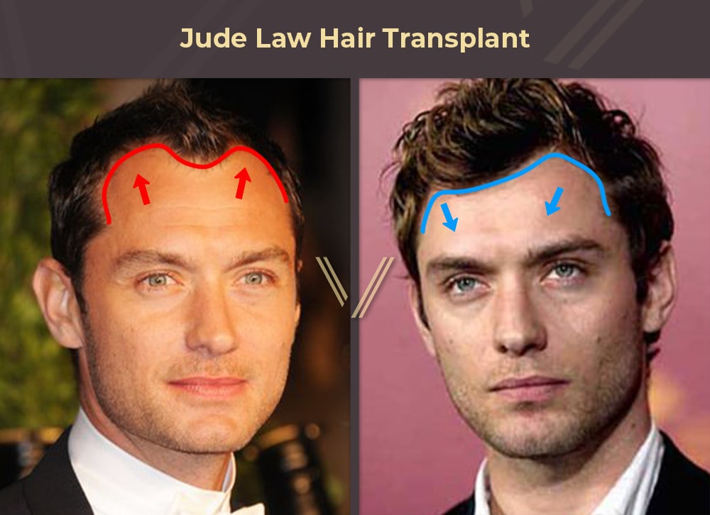Jude Law Hair Transplant Before and After