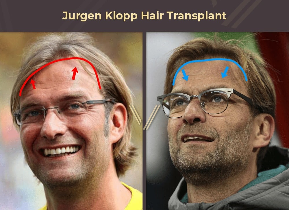 Jurgen Klopp Hair Transplant Before and After