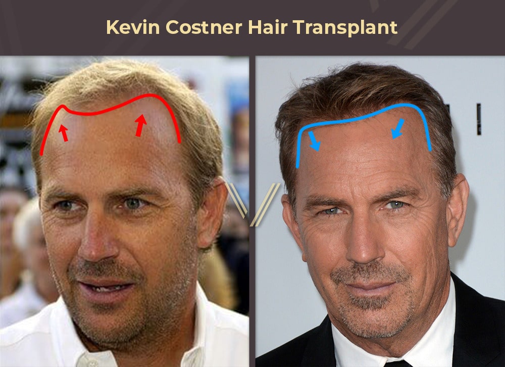 Kevin Costner Hair Transplant Before and After