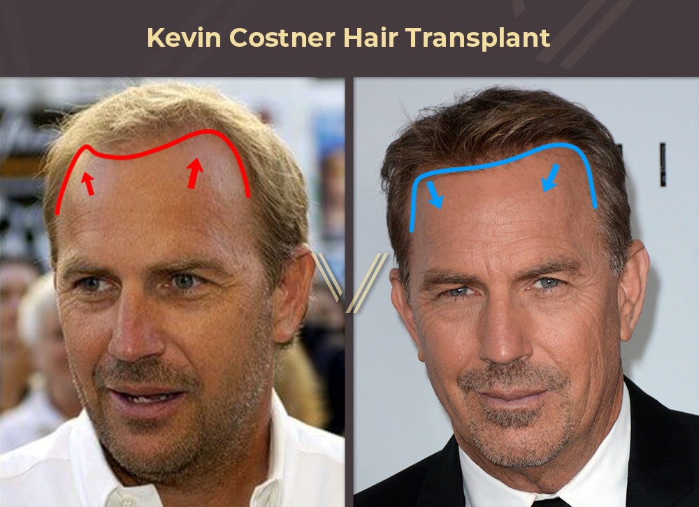 Celebrities With Hair Transplants 94 Before After Photos