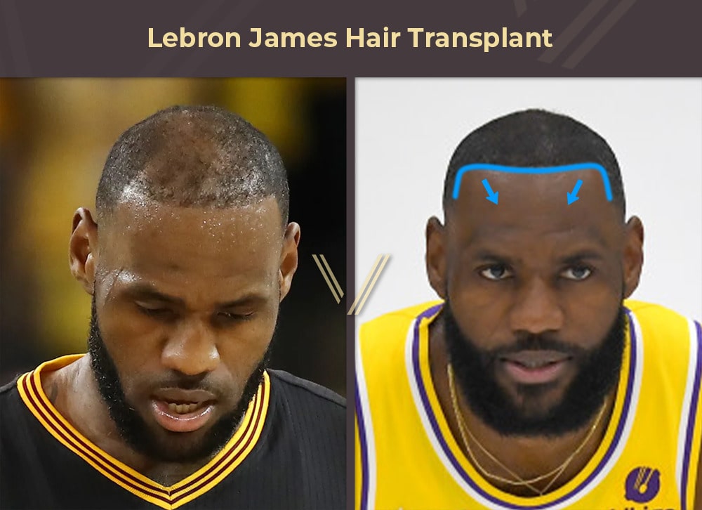 Lebron James Hair Transplant Before and After