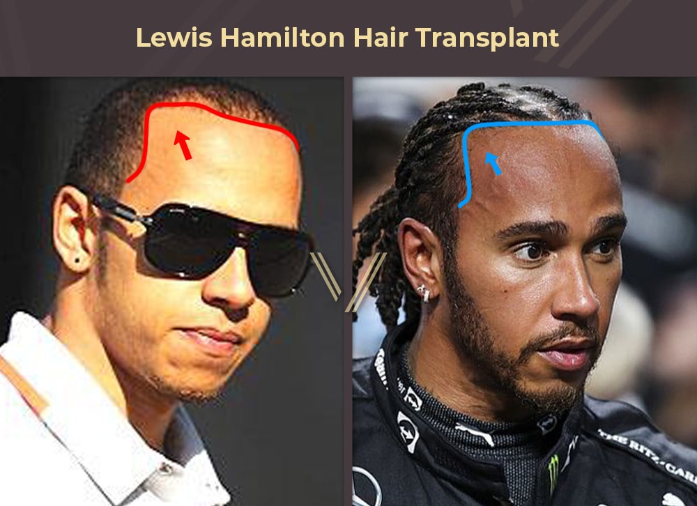 celebrity hair transplant before and after