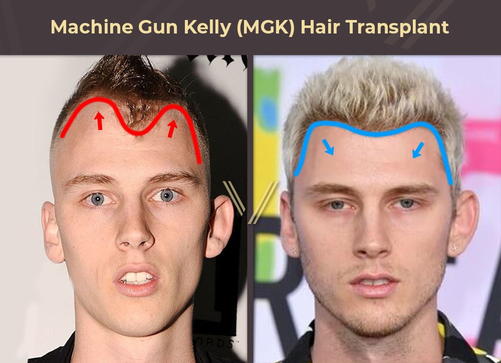 Machine Gun Kelly Hair Transplant Before and After