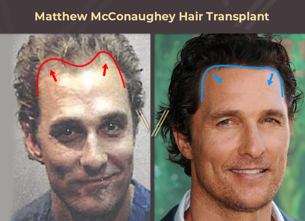 Matthew McConaughey Hair Transplant Before and After