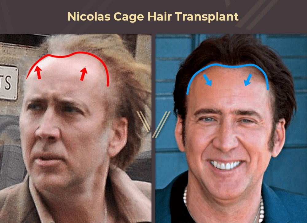 Nicolas Cage Hair Transplant Before and After