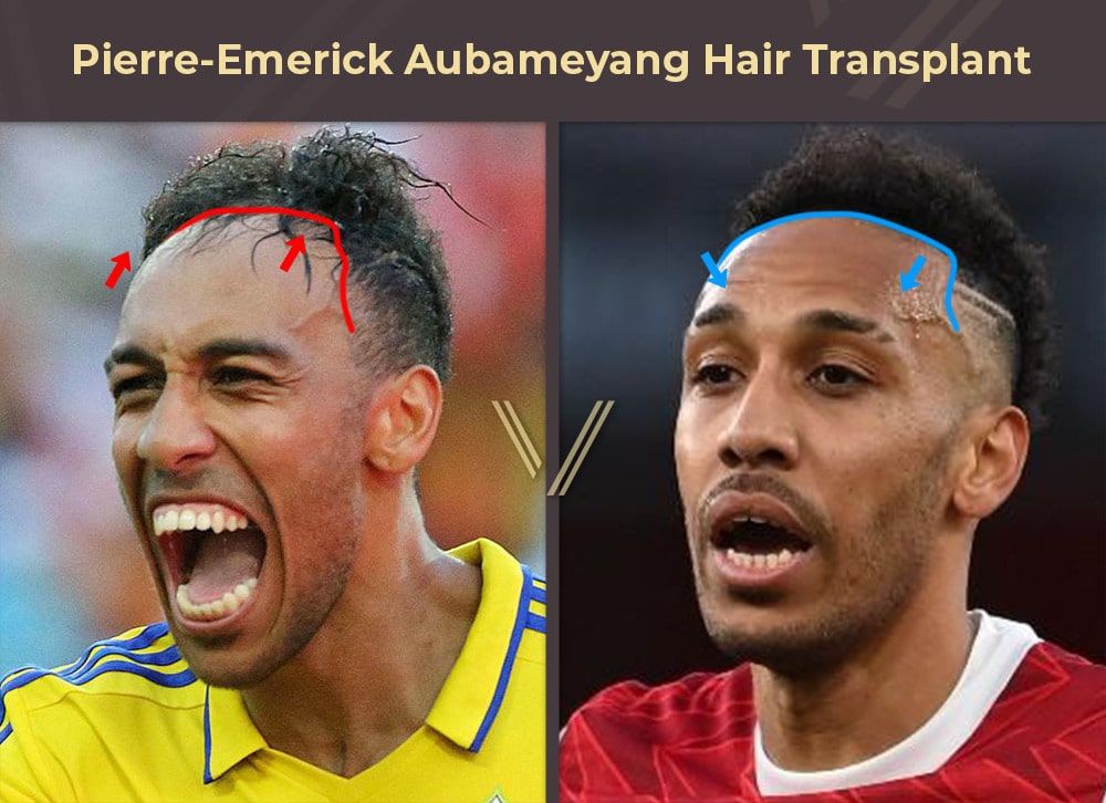 Pierre-Emerick Aubameyang Hair Transplant Before and After