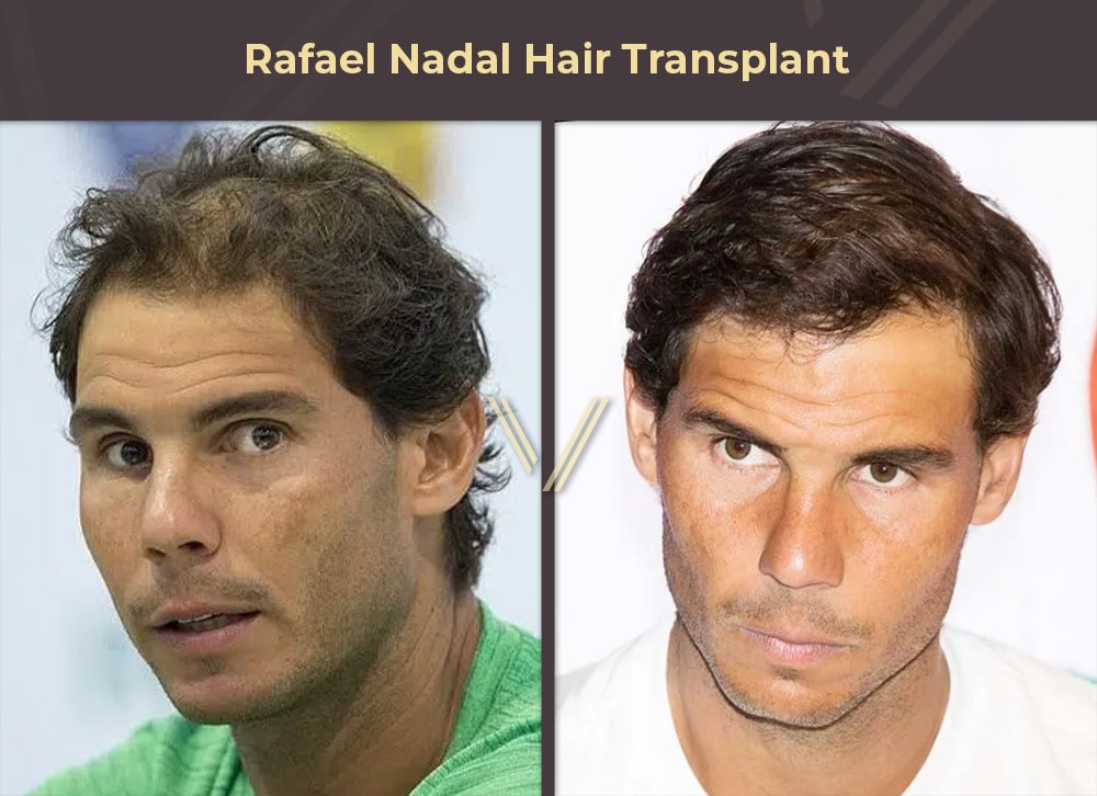 Rafael Nadal Hair Transplant Before and After