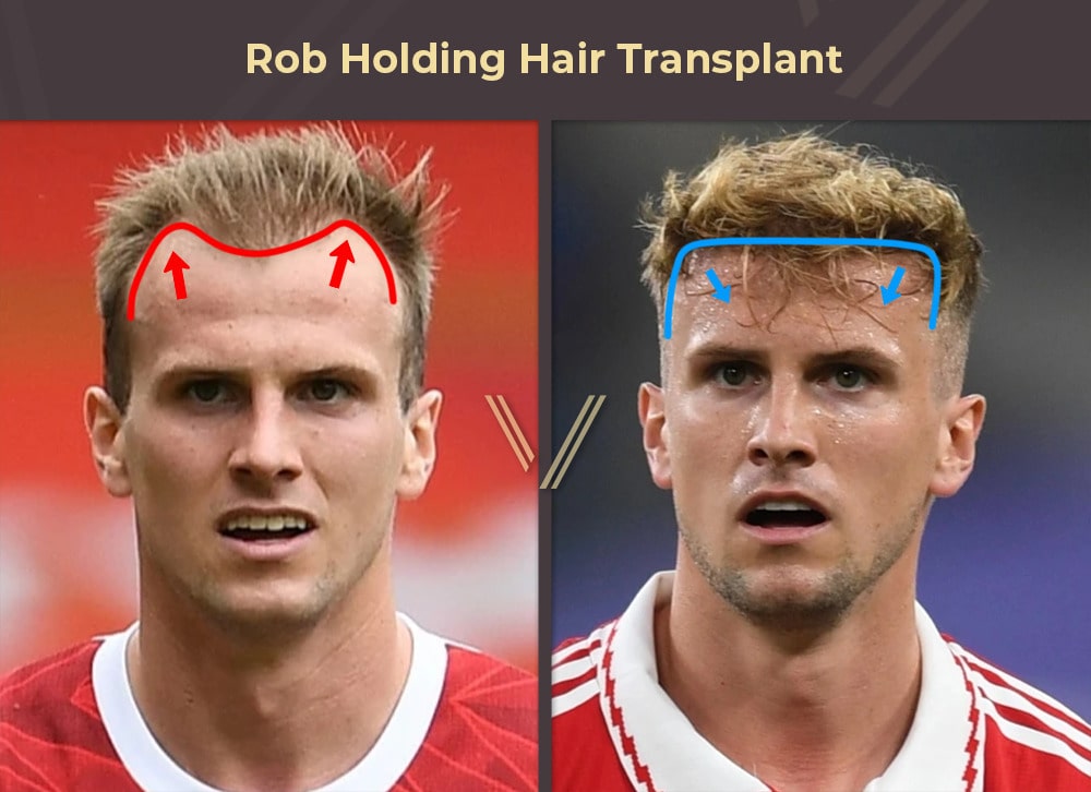 Rob Holding Hair Transplant Before and After