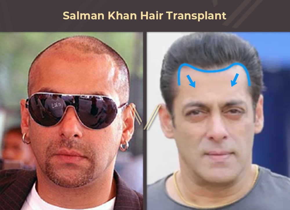 Salman Khan Hair Transplant Before and After