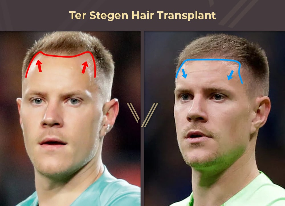 Ter Stegen Hair Transplant Before and After