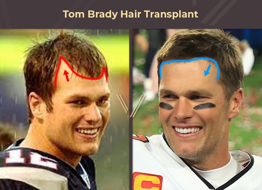 Tom Brady Hair Transplant Before and After