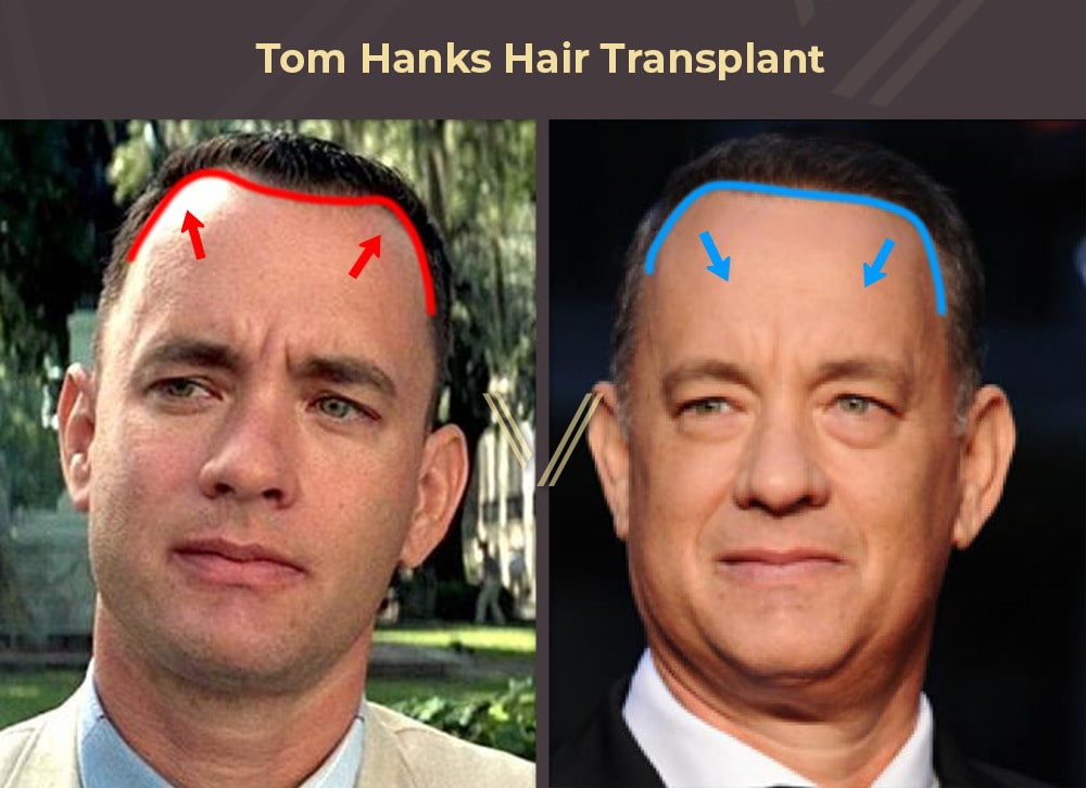 Tom Hanks Hair Transplant Before and After