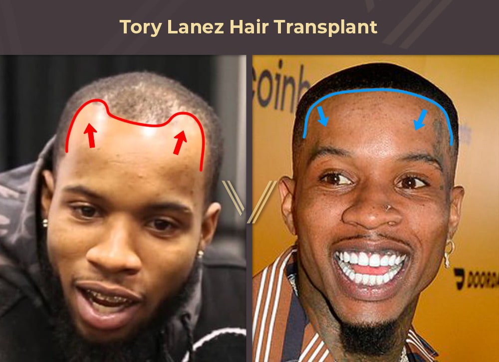 Tory Lanez Hair Transplant Before and After