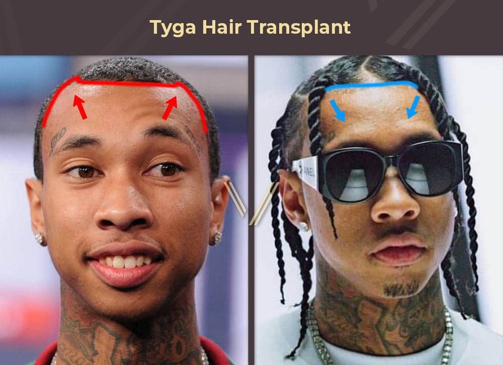 Tyga Hair Transplant Before and After