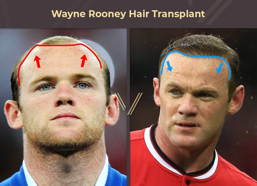 Wayne Rooney Hair Transplant Before and After