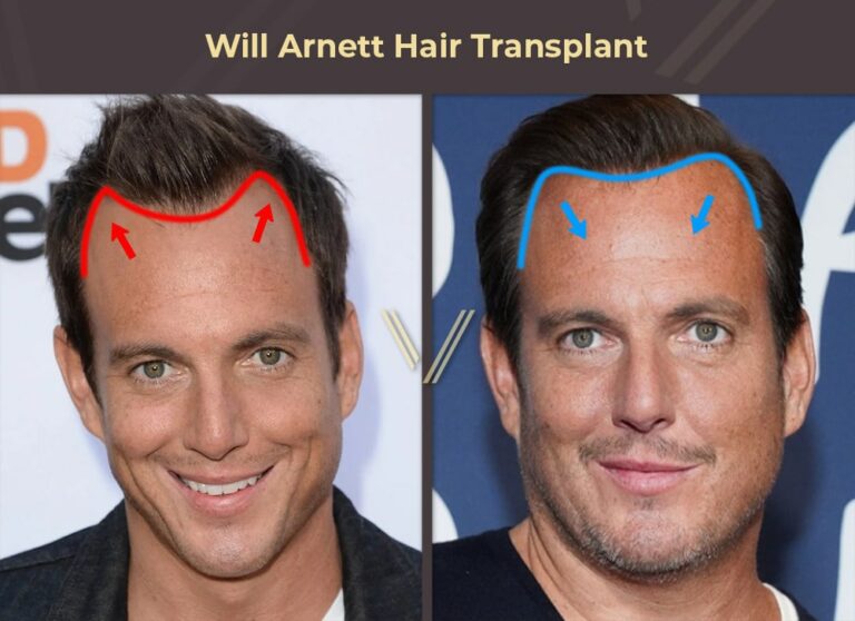 Celebrities With Hair Transplants | 97 Before & After Photos