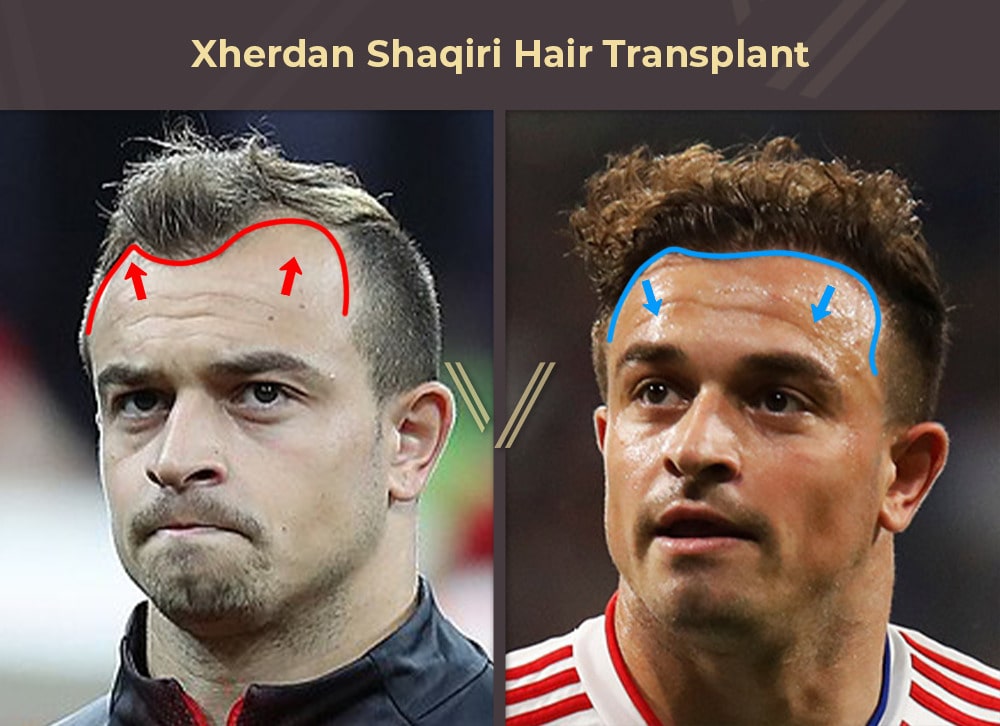 Xherdan Shaqiri Hair Transplant Before and After