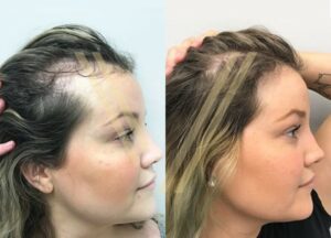 female hair transplant result