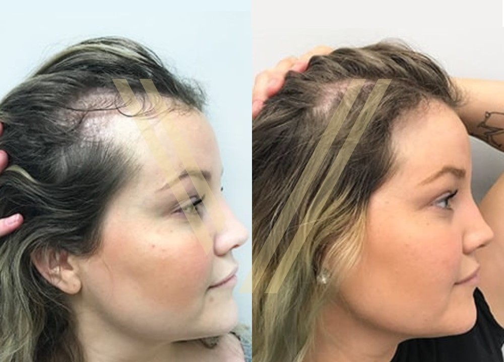 Female Hair Transplant Prices and Procedures 2024