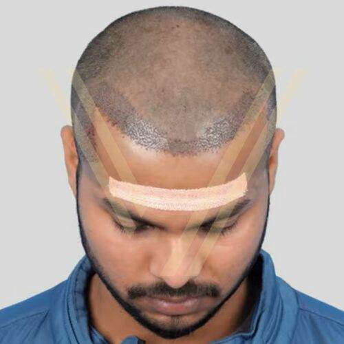 Get rid of a thinner scalp with hair transplant that gives permanent and  naturallooking Results