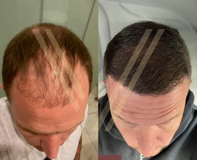 a very successful result on hair graft survival