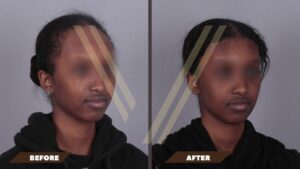 hairline lowering forehead reduction surgery female before and after