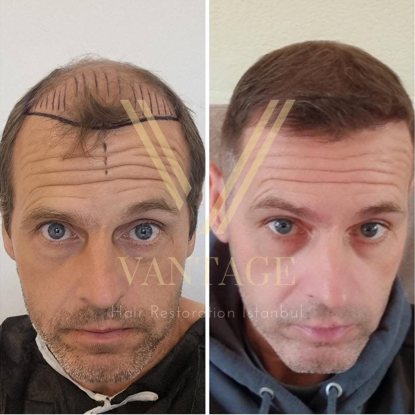 NeoGraft Hair Transplant in Turkey Costs in 2024 Vantage