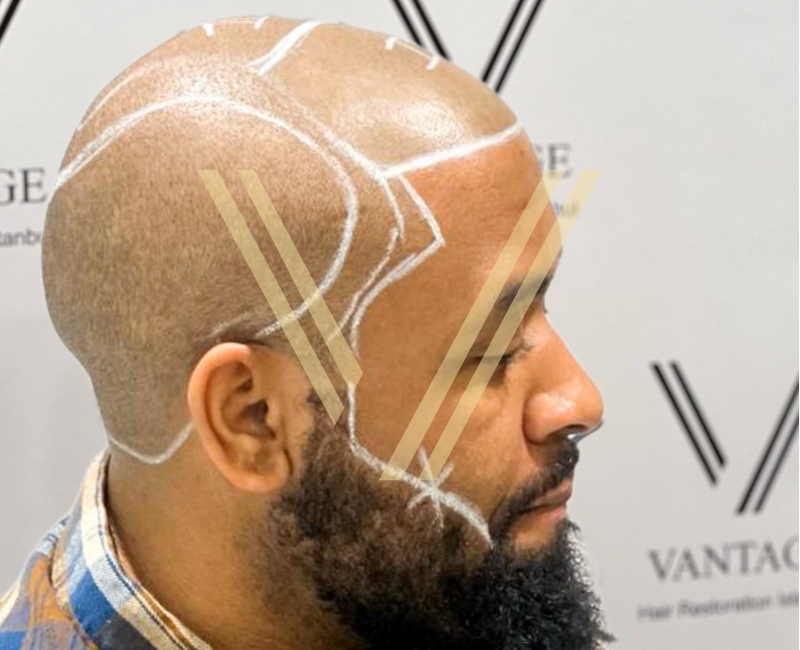 Afro-Hair-Transplant-Patient-Before-Operation