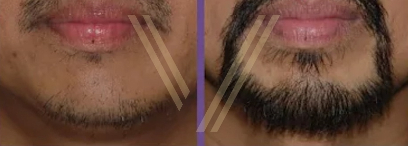 asian facial hair transplant before and after photo