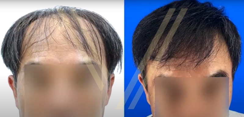 Asian hair transplant before and after photo