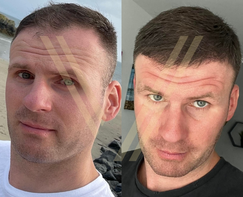 before after photo of male hair transplant