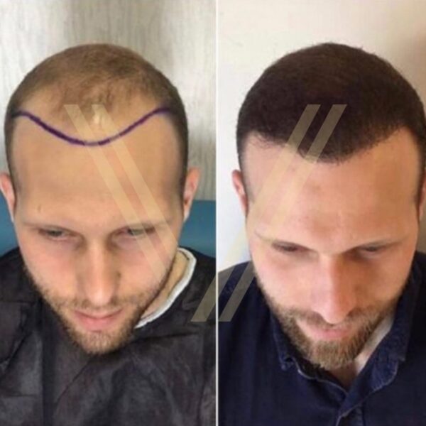 dhi hair transplant result before after photo