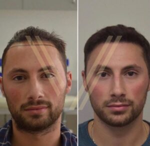 dhi hair transplant in istanbul before after