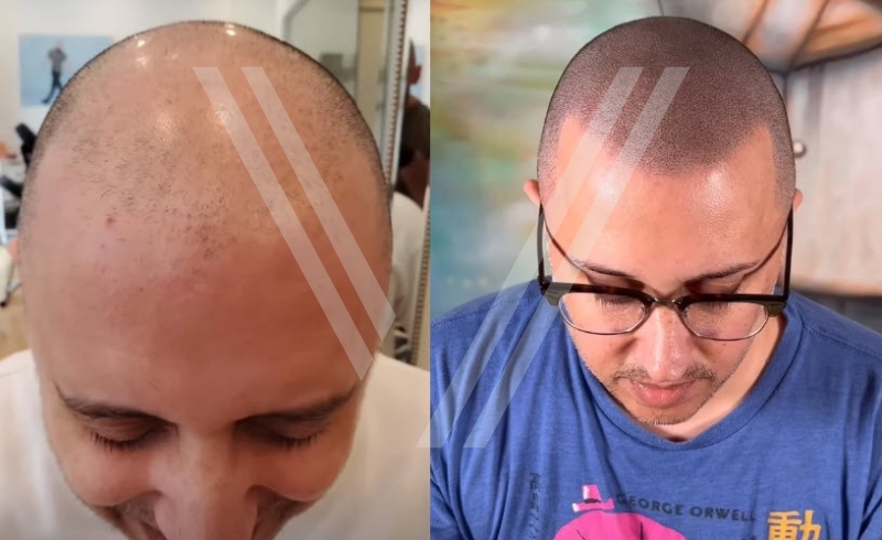 hair tattoo scalp micropigmentation patient istanbul