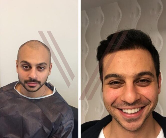 hair transplant 5000 grafts before after
