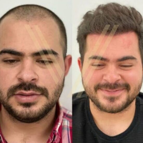 hair transplant istanbul before after fue result