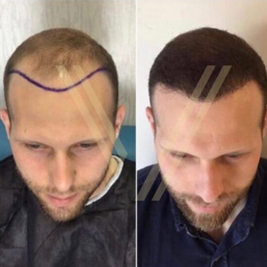vantage clinic - dhi hair transplant result before after photo