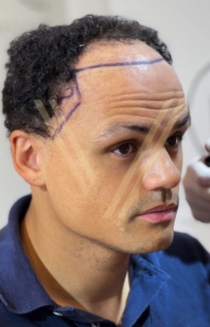 hiv hair transplant patient curly hair