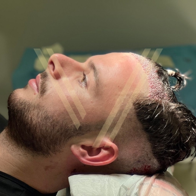 no shave hair transplant post-op