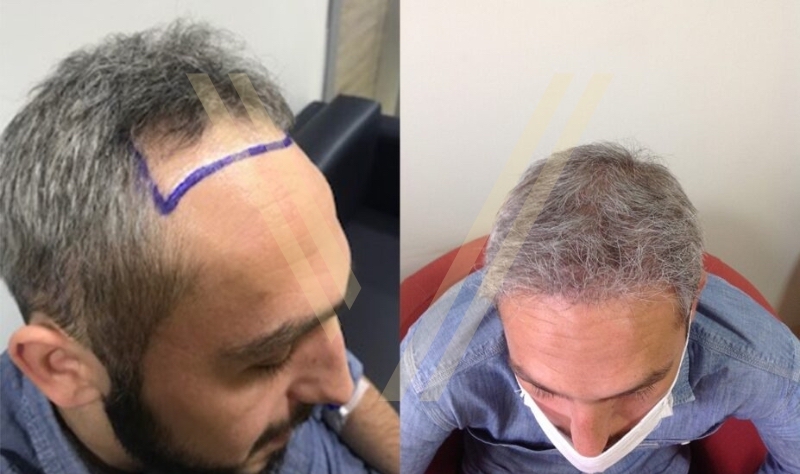 hair transplant result -before and after photo in istanbul turkiye