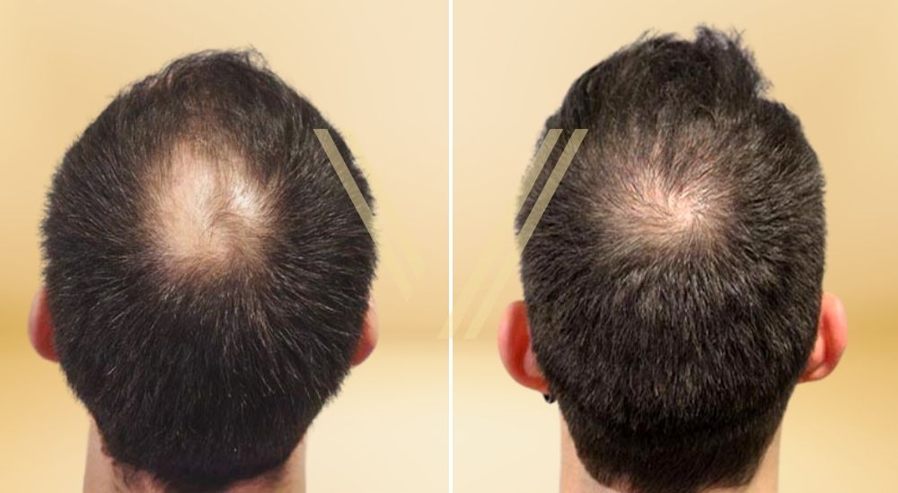 This image is a before after photo shoot of a patient in Istanbul after crown (vertex) hair transplant