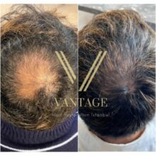 Crown hair transplant in Turkey