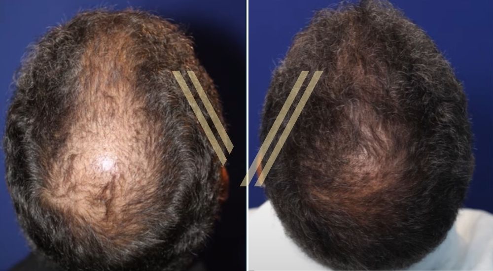 This image is a before after photo shoot of a patient in Istanbul after crown (vertex) hair transplant