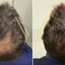 before after photo shoot of a patient in Istanbul after crown (vertex) hair transplant