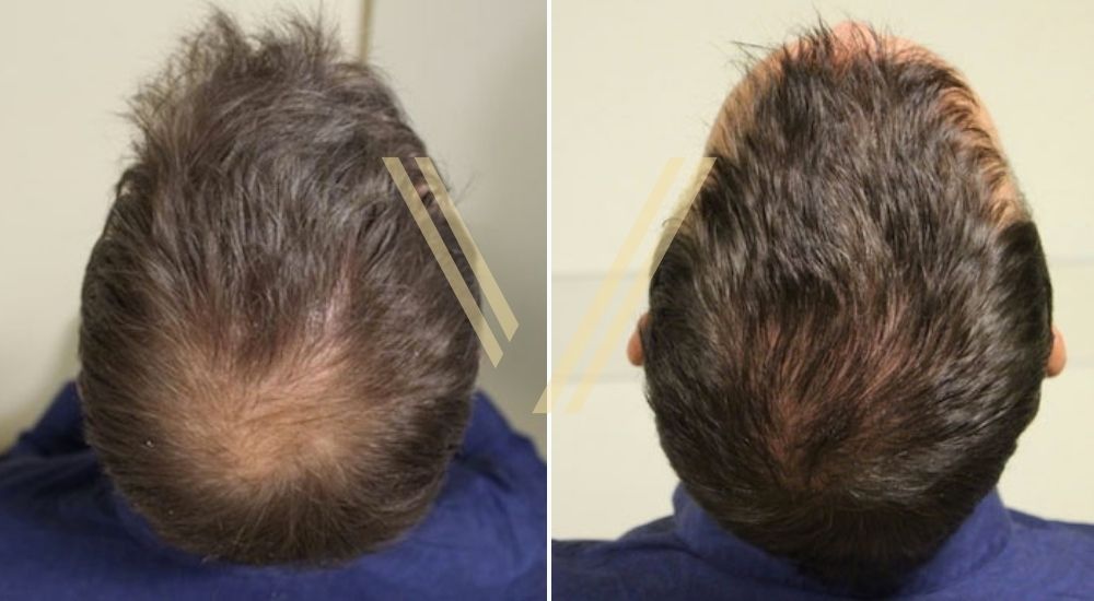 before after photo shoot of a patient in Istanbul after crown (vertex) hair transplant