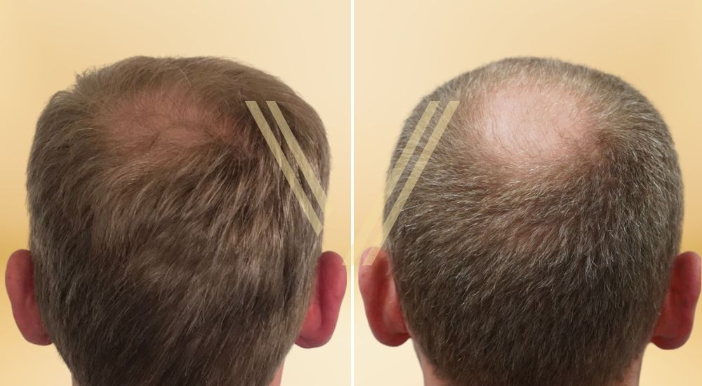 This image is a before after photo shoot of a patient in Istanbul after crown (vertex) hair transplant