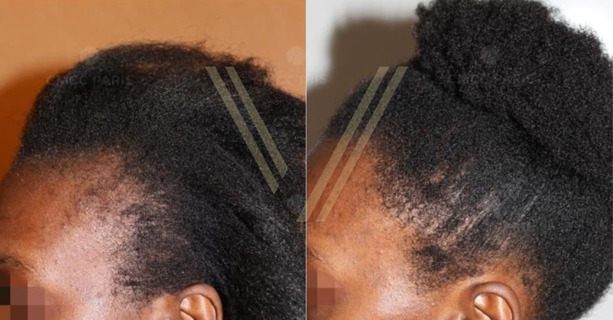 Afro female hair transplant before and after result