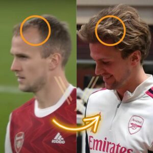 before after hair transplant rob holding