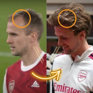 Rob Holding's Hair Transplant: Before and After Transformation